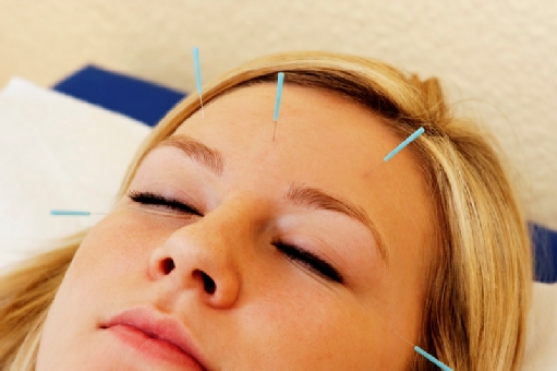 IGeL Leistung Akupunktur